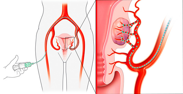 Эмболизация маточных артерий при миоме матки цена москва thumbnail