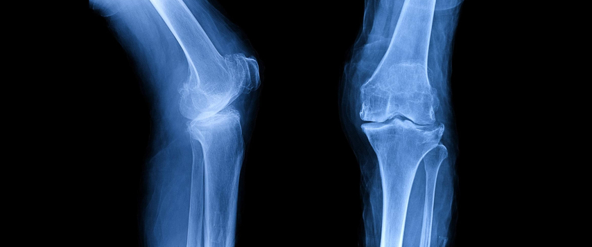 Рентген коленного сустава в Москве: цена, сделать снимок, адреса – СМ-Клиника