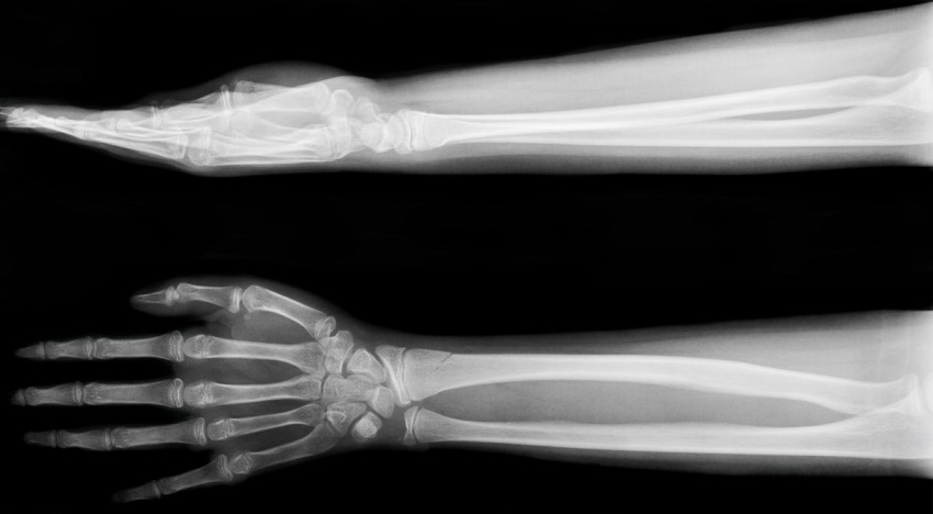 Рентген пальцев рук