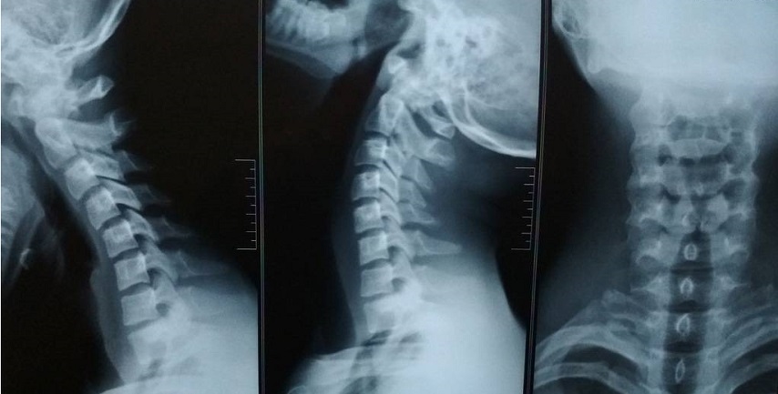 Рентгеновский снимок спины и шеи мужчины - скачать фото бесплатно | Flyvi