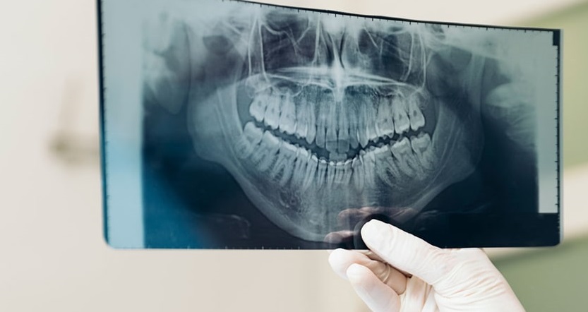 Диагностика при имплантации зубов. Традиционный рентген или КТ? - Диагностический кабинет 3D KT+